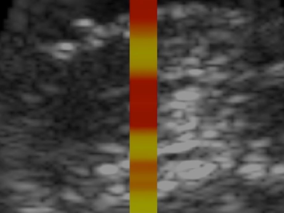 TAEUS® Tissue Composition analysis for quantification of liver fat
